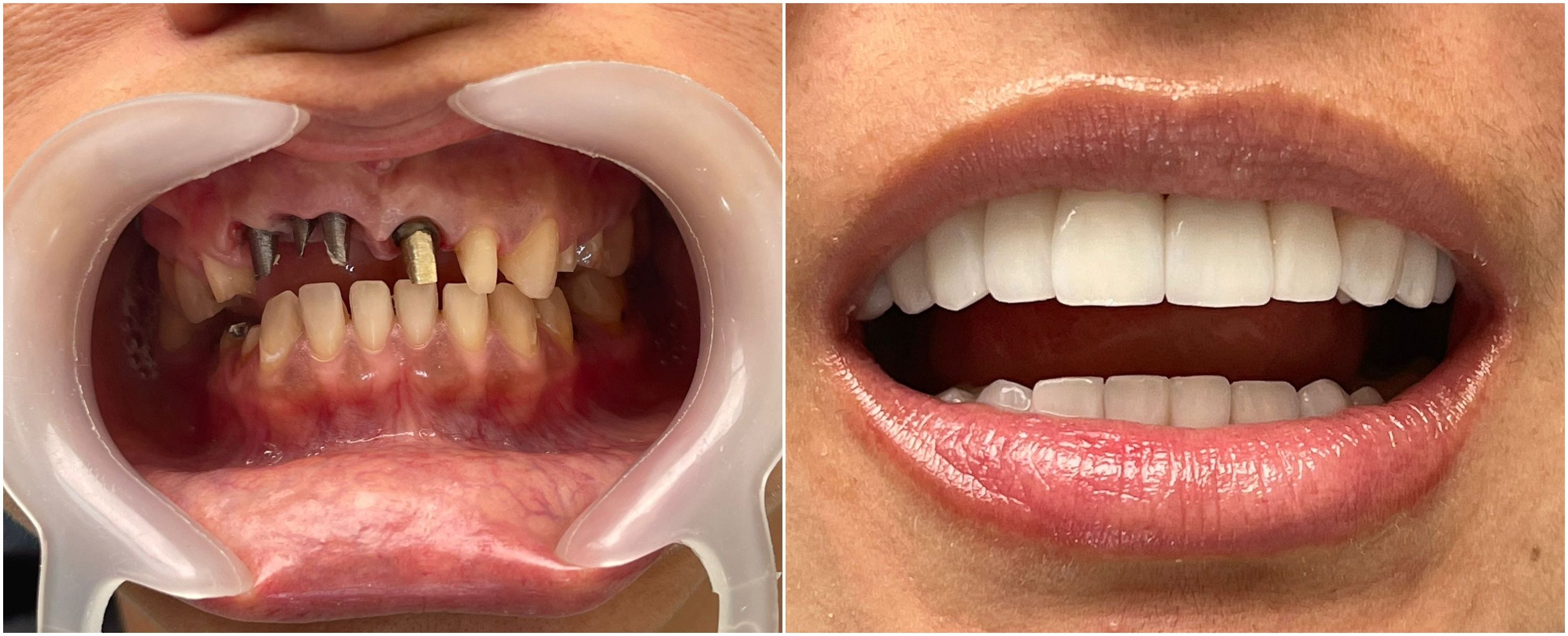 Implantes dentales Antes y después Clinicasesteticas co