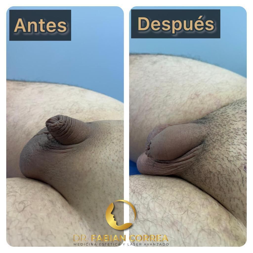 Alargamiento de pene Antes y después Clinicasesteticas co