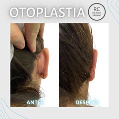 Otoplastia - Dra. Lorena Pedroza y Dr. Gonzalo Rueda