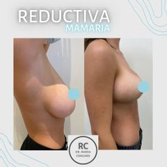 Reducción de mamas - Dra. Lorena Pedroza y Dr. Gonzalo Rueda