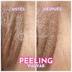 Peeling Vulvar - Dra. Lorena Pedroza y Dr. Gonzalo Rueda