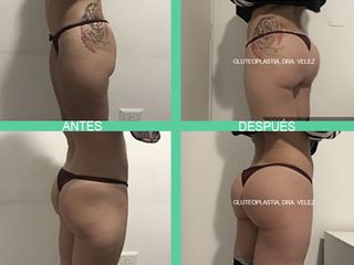 Gluteoplastia