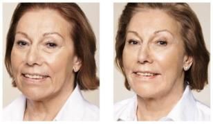 Antes y después de un tratamiento de rejuvenecimiento facial