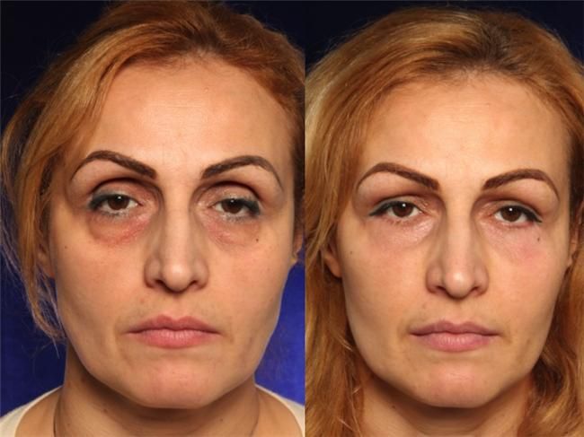 Antes y después de un tratamiento de ojeras