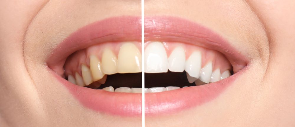 foto de antes y después de un blanqueamiento dental