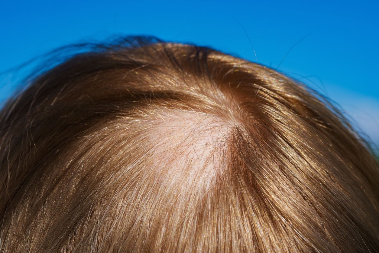 Alopecia