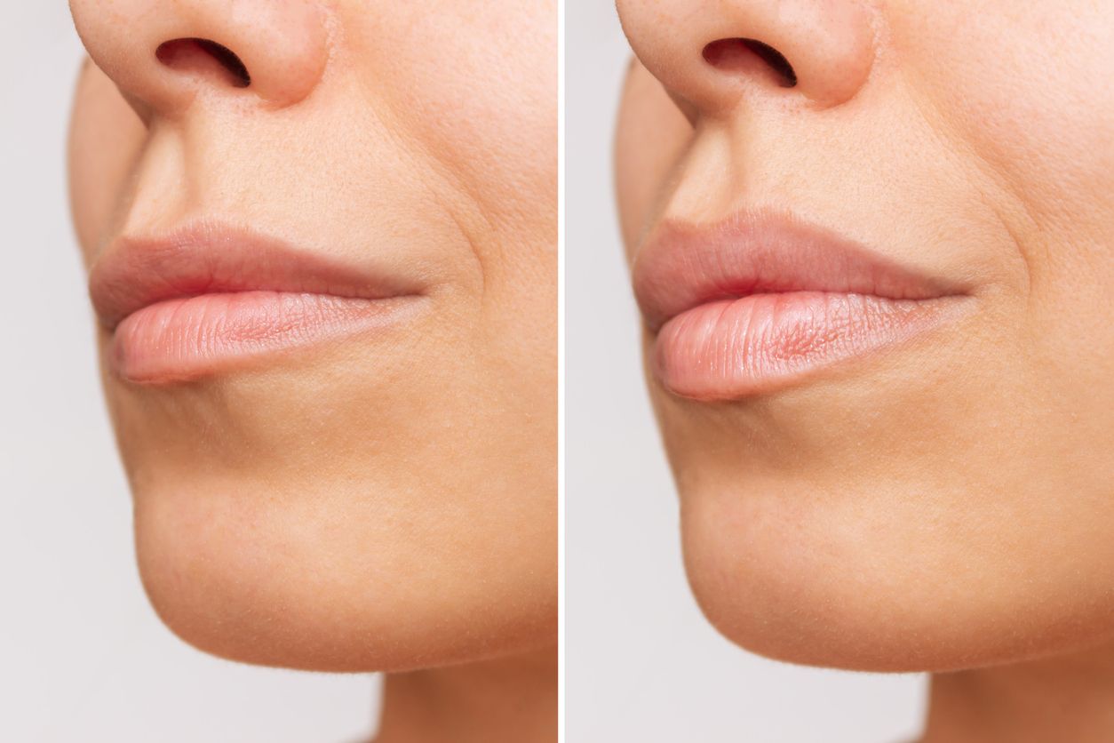 Aumento de labios antes y después