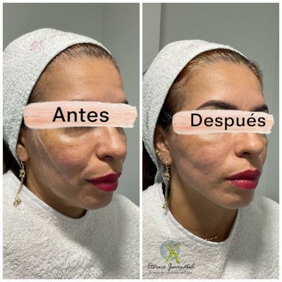rostro de mujer antes y después de un tratamiento de hilos tensores
