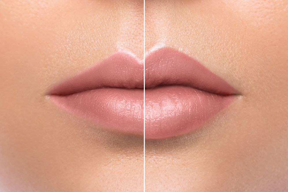 Foto de antes y después de un aumento de labios