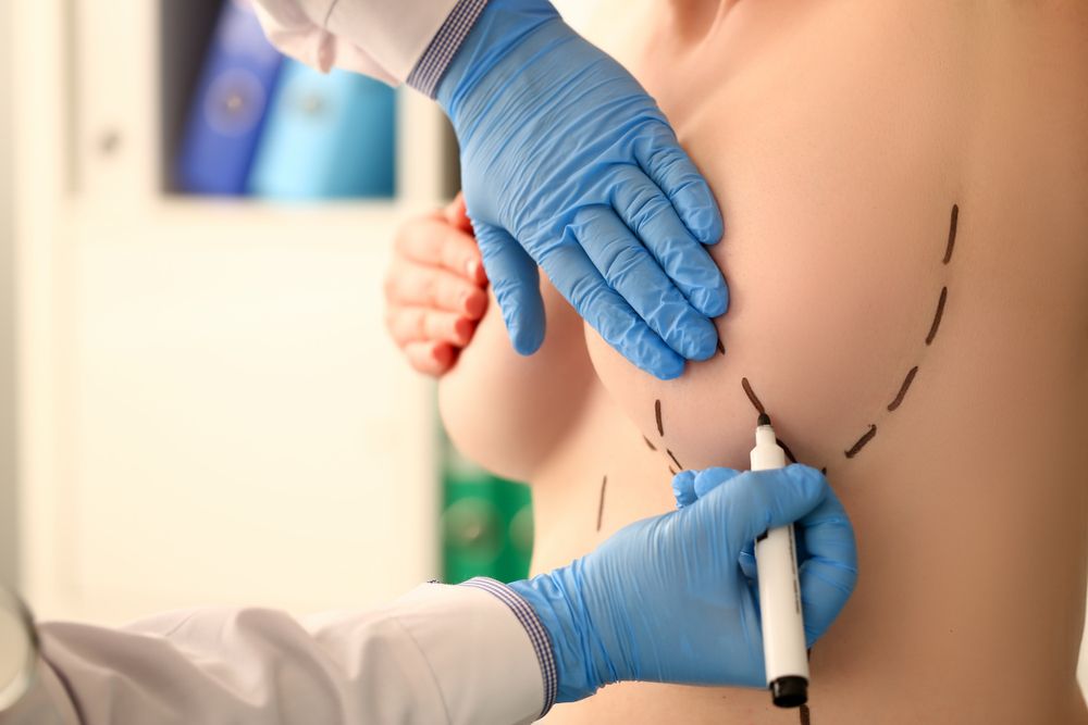 médico haciendo marcas en el seno de paciente