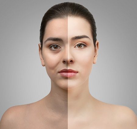 antes y después de un rejuvenecimiento facial