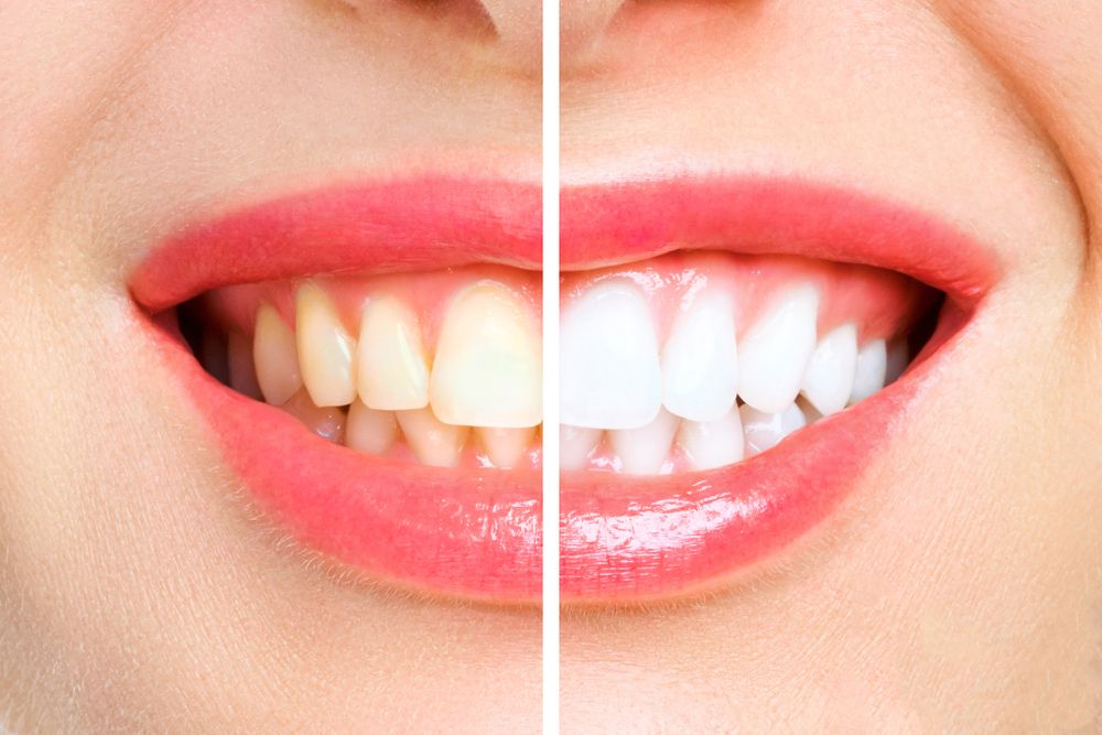 antes y después de un blanqueamiento dental