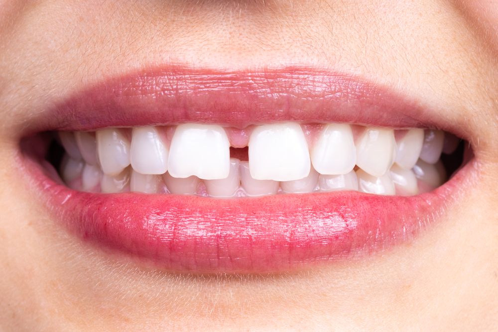 Mujer con dientes separados