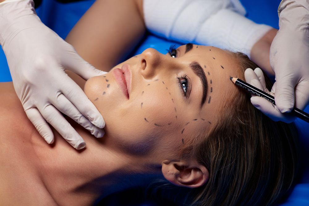 mujer con marcas para una cirugía facial