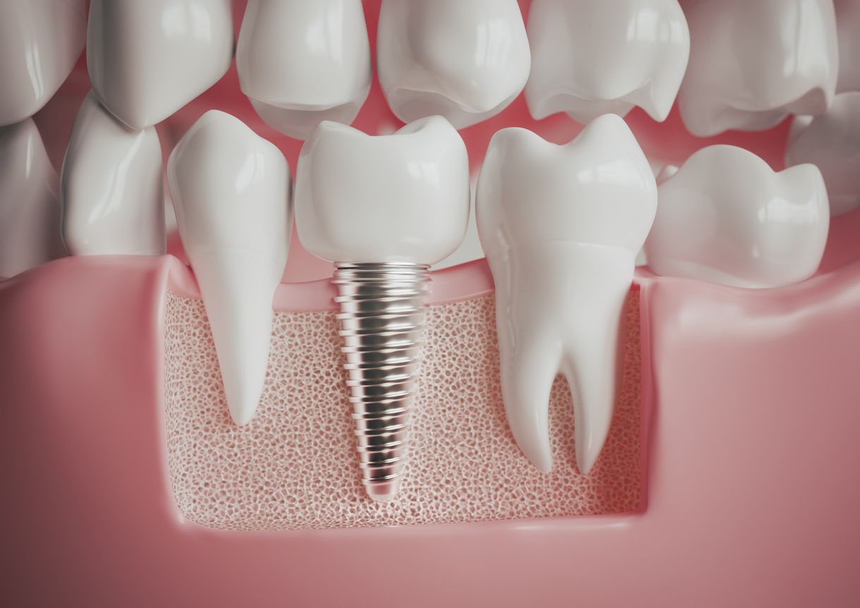 los implantes dentales tienen forma de tornillo