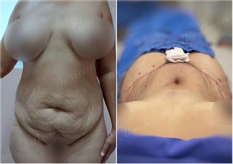 Abdominoplastia - Dr. Alan Sóstenes