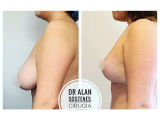 Mastopexia - Dr. Alan Sóstenes