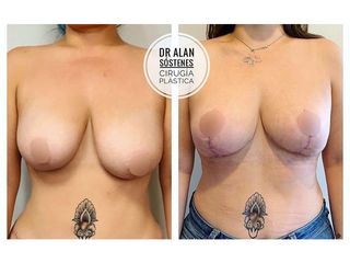 Mastopexia - Dr. Alan Sóstenes