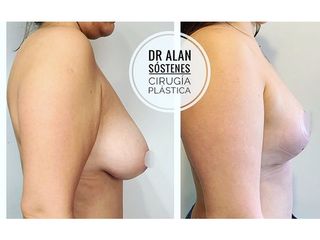 Mastopexia - Dr. Alan Sóstenes