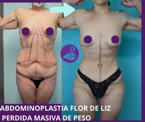 Abdominoplastia - Dra. Jessica Ramírez Cadena
