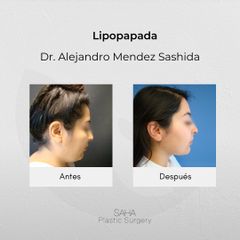 Cirugía de papada - Dr. Alejandro Méndez Sashida