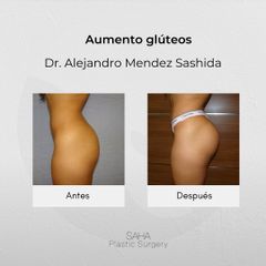Gluteoplastia - Dr. Alejandro Méndez Sashida