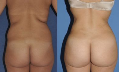 Antes y después de Liposucción