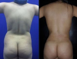 Antes y después de Liposucción