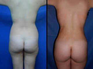 Antes y después de Liposucción