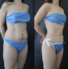 Antes y después de Abdominoplastia + Liposucción