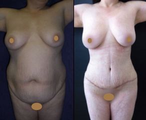 Antes y después de Abdominoplastia + Liposucción