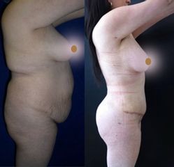 Antes y después de Liposucción + Abdominoplastia