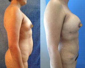 Antes y después de Aumento de busto