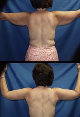 Antes y después de Braquioplastia