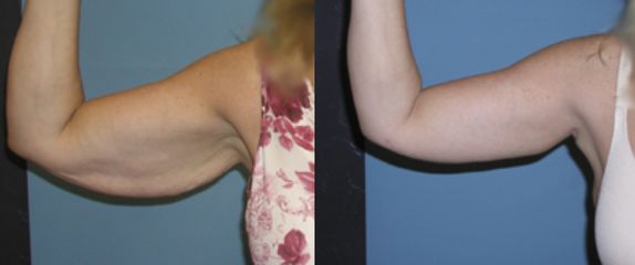Antes y después de Braquiplastia