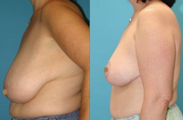 Antes y después de Mastopexia