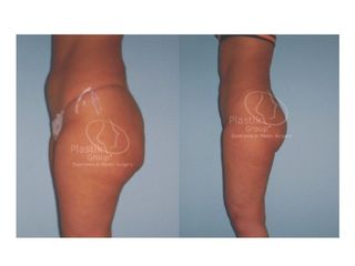Antes y después de Lipoescultura 