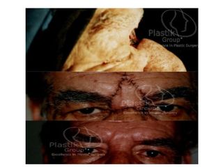 Antes y después de  Rec-Ca espinosel