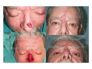 Antes y después de Reconstrucción nasal 