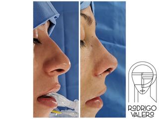 Rinoplastia - Dr. Rodrigo Valero Jarillo