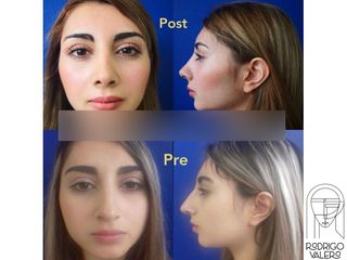 Rinoplastia - Dr. Rodrigo Valero Jarillo