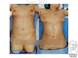Liposucción - Dr. Rodrigo Valero Jarillo
