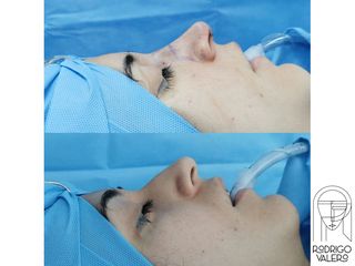 Rinoplastia - Dr. Rodrigo Valero Jarillo