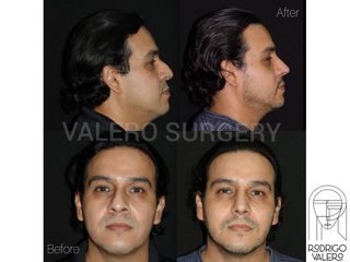 Rinoplastia - Dr. Rodrigo Valero Jarillo