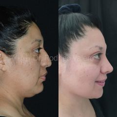 Rinoplastia - Dr. Rodrigo Valero Jarillo