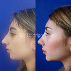 Rinoplastia - Dr. Rodrigo Valero Jarillo