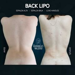 Liposucción - Dr. Rodrigo Valero Jarillo