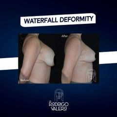 Mastopexia - Dr. Rodrigo Valero Jarillo