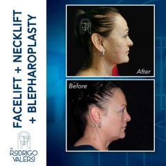 Facelift - Dr. Rodrigo Valero Jarillo