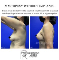 Mastopexia - Dr. Rodrigo Valero Jarillo